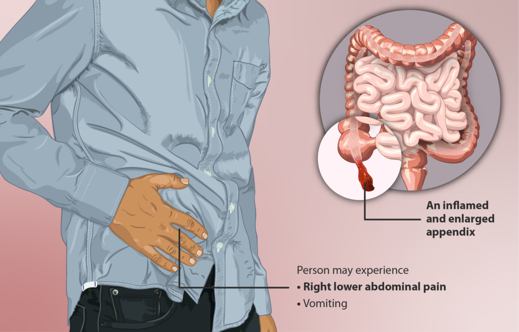 burst appendix symptoms