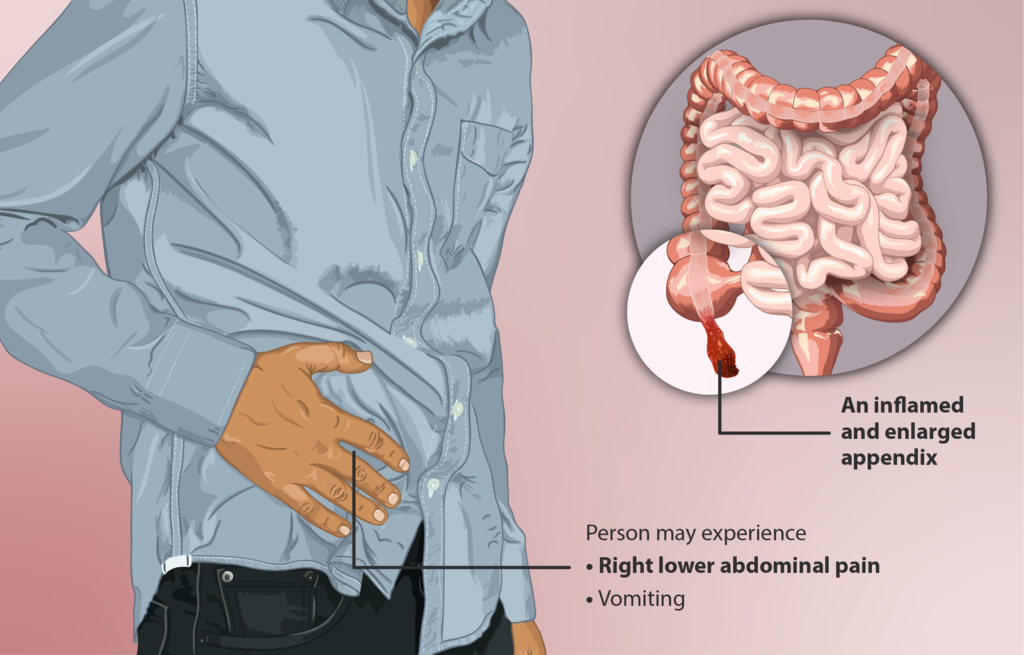 perforated appendix