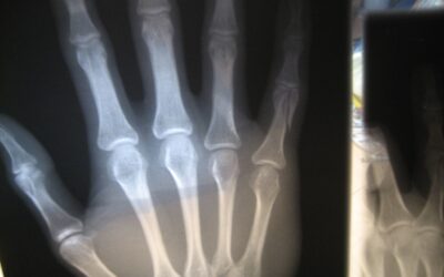 Were You Discharged from the Hospital with a Fracture?