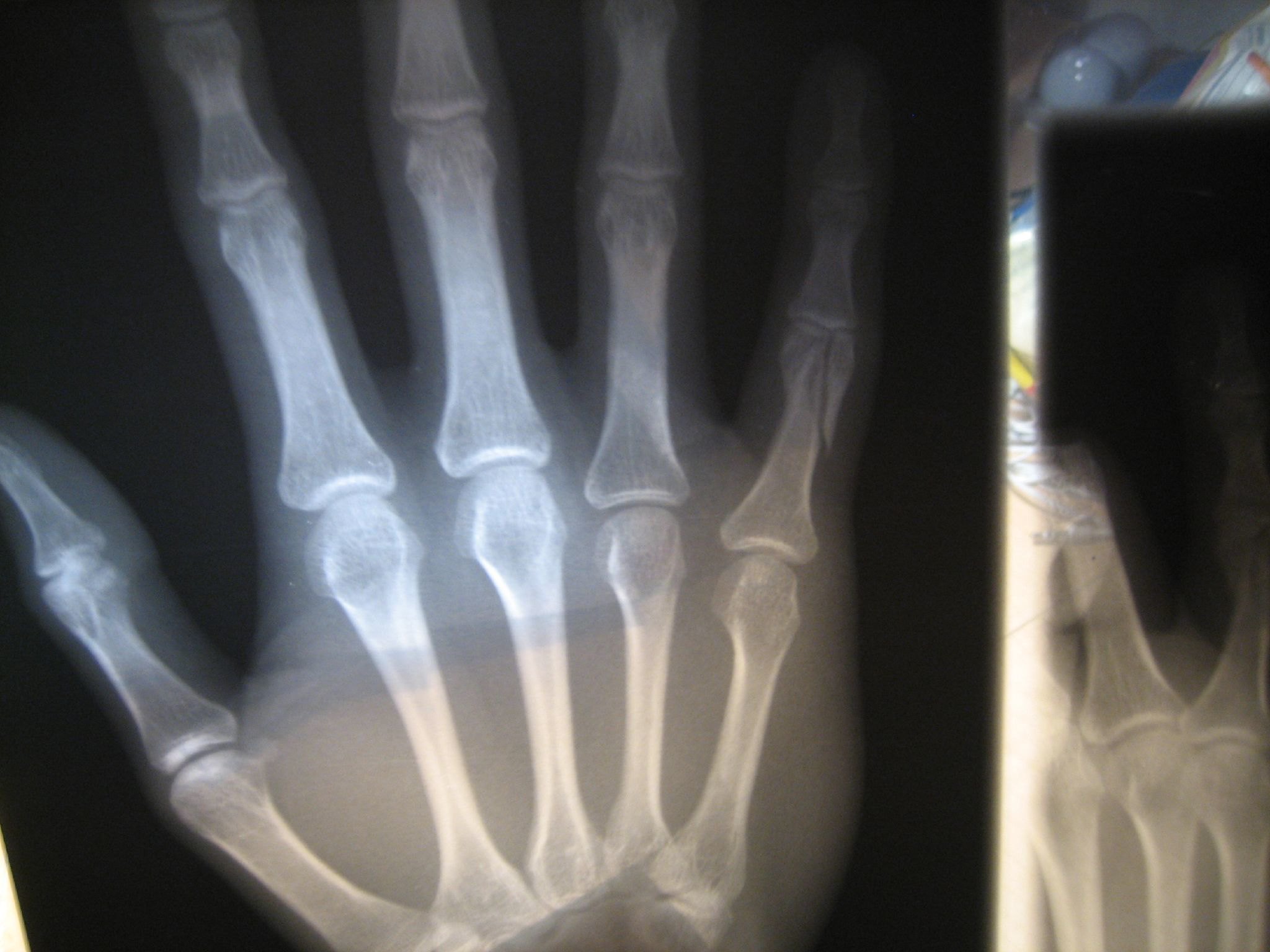 xray of broken finger