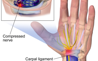 Can You Develop Carpal Tunnel Syndrome from Car or Truck Accidents?