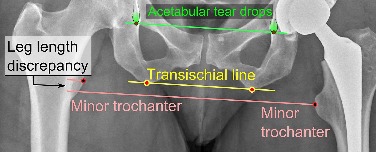 Leg Length Discrepancy After Hip Surgery How Do You Know It's Worth A