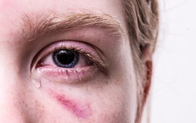 Eight Most Common Eye Injuries and Their Causes