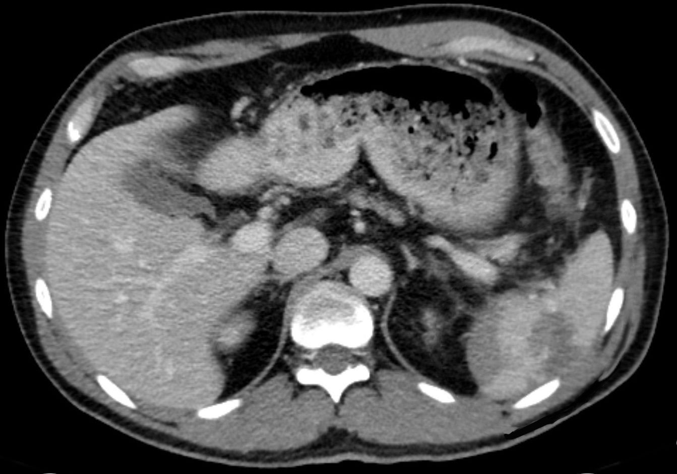 The Symptoms and Causes of a Ruptured Spleen - The Thistle Law Firm